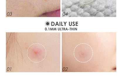 Acne Pimple Patch